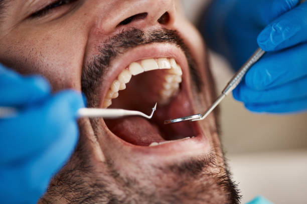 Best Chipped Tooth Repair Near Me  in Gulf Park Estates, MS